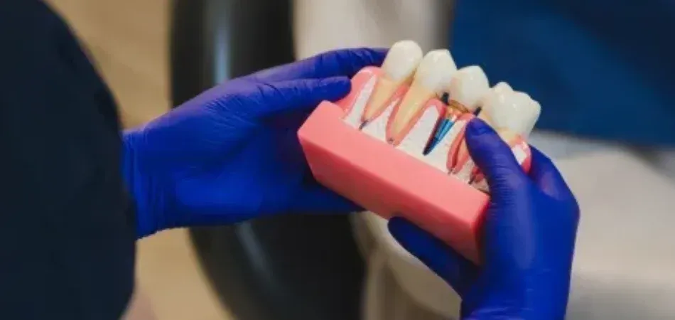 Model pokazujący implant w kości, łącznik i koronę obok naturalnych zębów