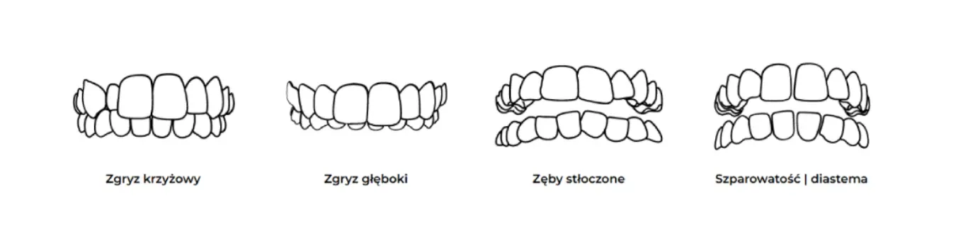 Rysunki wad zgryzu: zgryz krzyżowy, zgryz głęboki, zęby stłoczone oraz szparowatość z diastemą